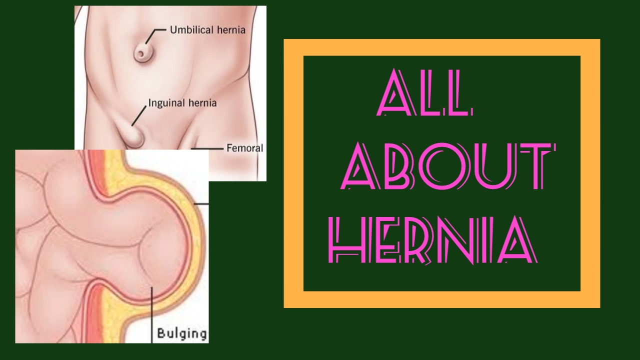 Hernia