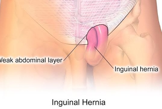 Types of hernia