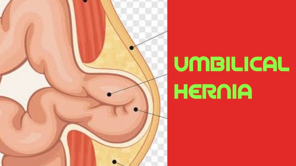 Types of hernia