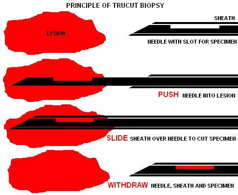 tru cut biopsy