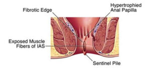 ANAL FISSURE TREATMENT