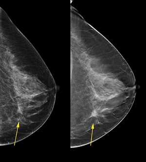 mammography