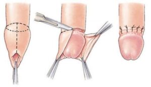 circumcision open