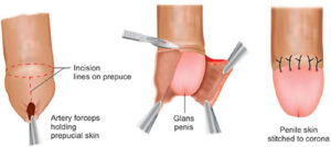 circumcision open