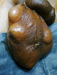 SCROTAL SEBACEOUS CYST