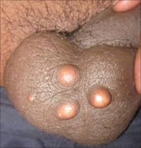 scrotal cyst