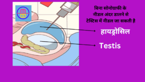 hydrocele kya hota hai