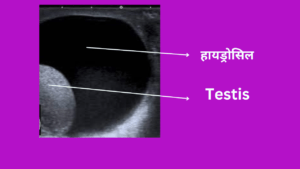 hydrocele kya hota hai