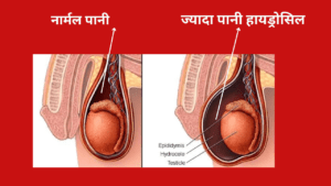 hydrocele kya hota hai