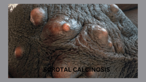 SCROTAL CALCINOSIS 