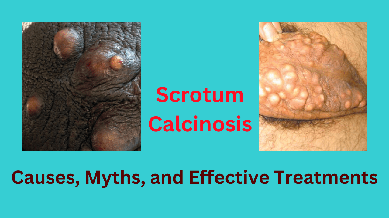 SCROTAL CALCINOSIS (3)