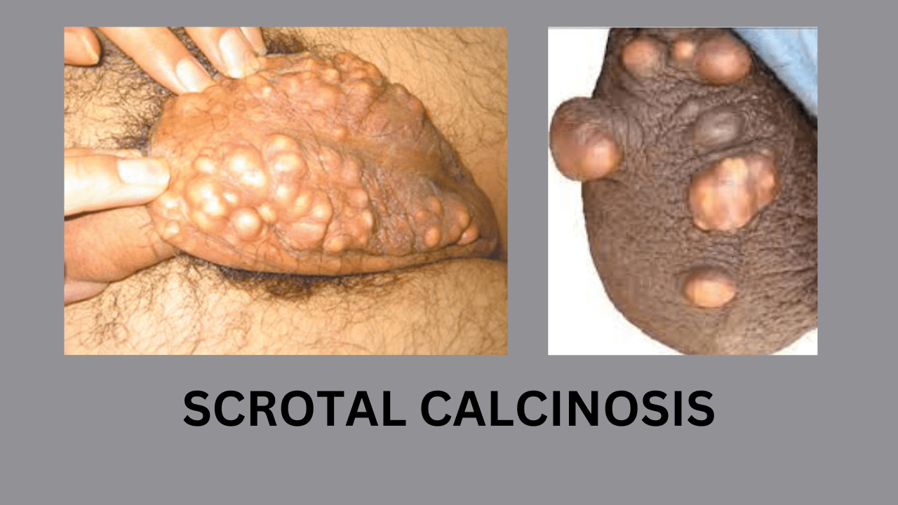 SCROTAL CALCINOSIS