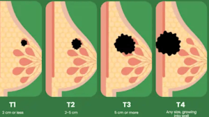 breast cancer stages