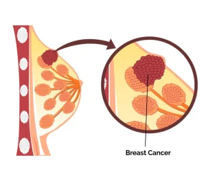 breast cancer